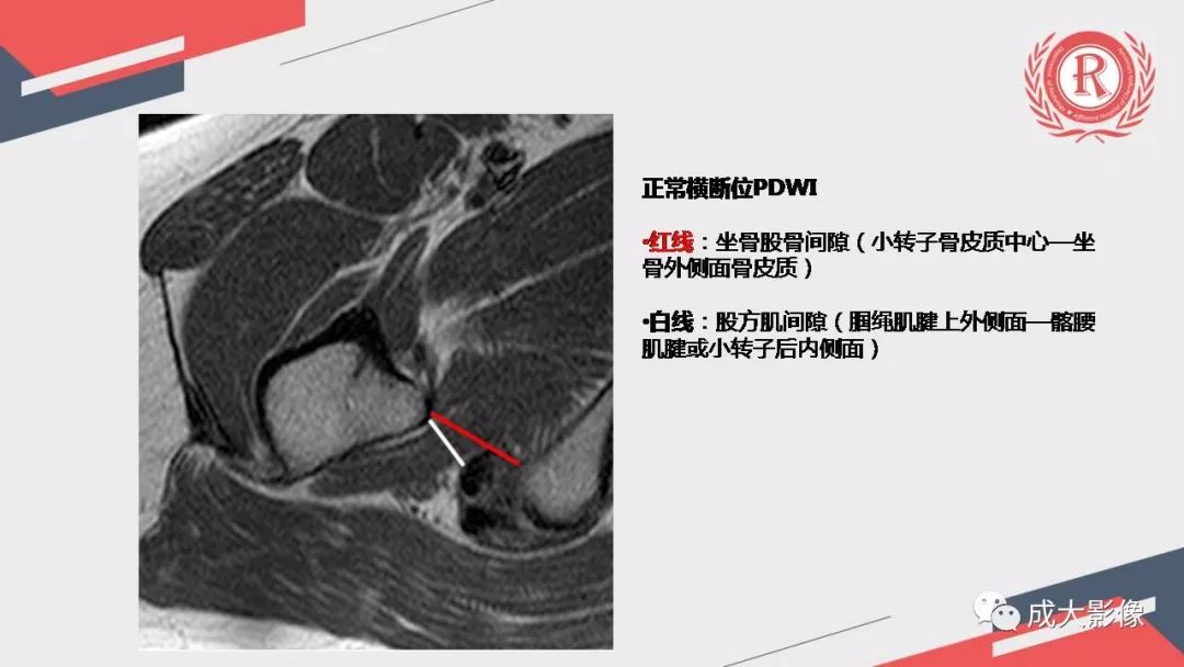 影像PPT - 【PPT】坐骨股骨撞击综合征MR影像诊断-18 影像PPT - 【PPT】坐骨股骨撞击综合征MR影像诊断-18