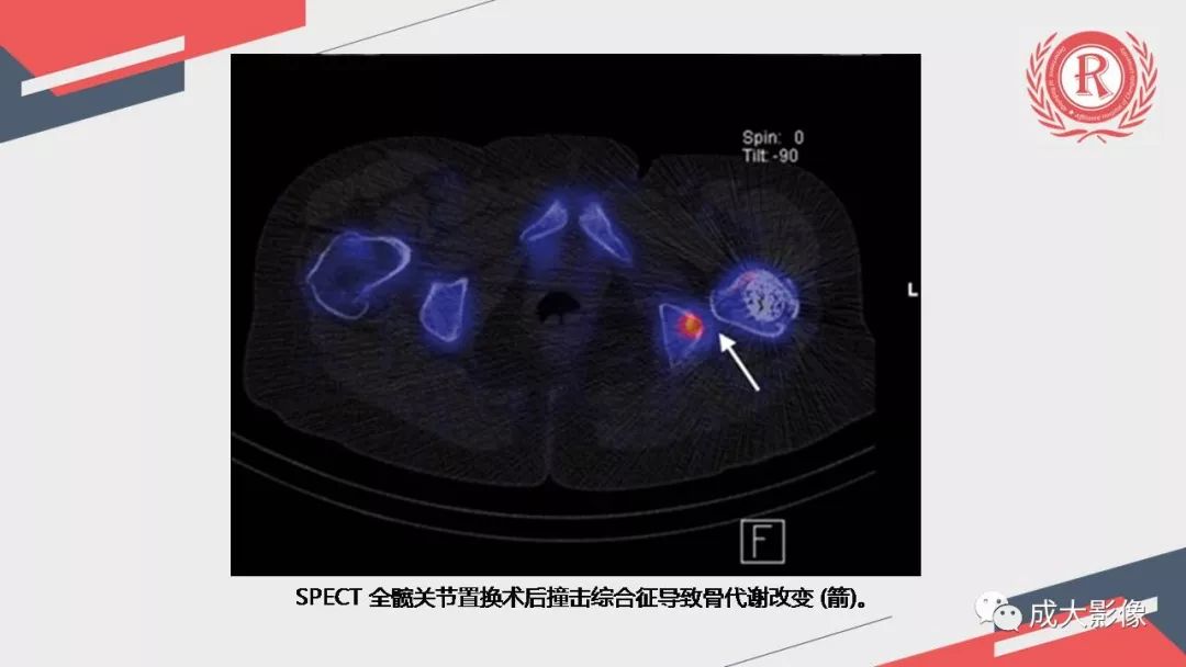 影像PPT - 【PPT】坐骨股骨撞击综合征MR影像诊断-20 影像PPT - 【PPT】坐骨股骨撞击综合征MR影像诊断-20