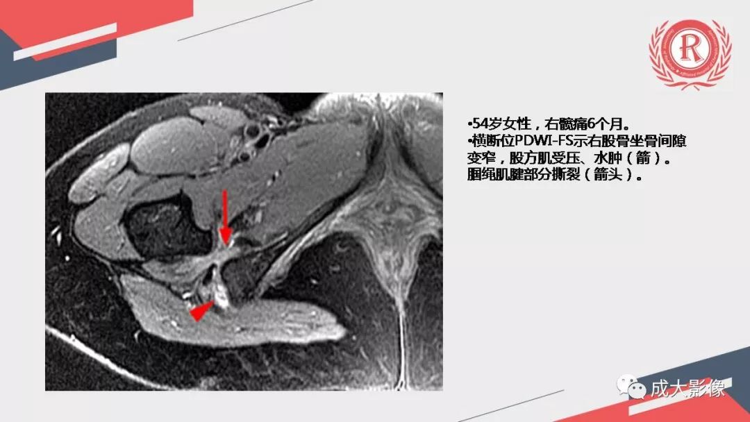 影像PPT - 【PPT】坐骨股骨撞击综合征MR影像诊断-23 影像PPT - 【PPT】坐骨股骨撞击综合征MR影像诊断-23