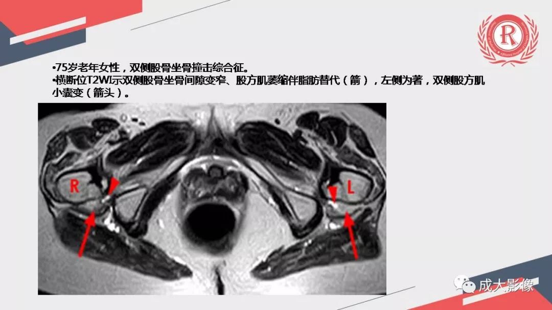 影像PPT - 【PPT】坐骨股骨撞击综合征MR影像诊断-24 影像PPT - 【PPT】坐骨股骨撞击综合征MR影像诊断-24