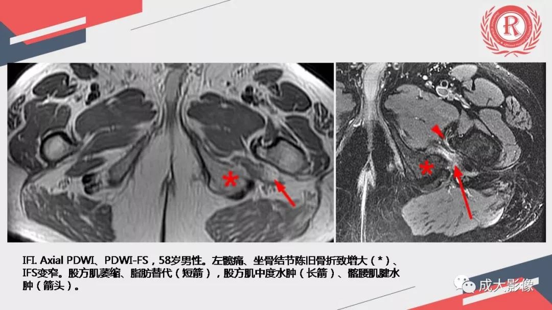 影像PPT - 【PPT】坐骨股骨撞击综合征MR影像诊断-29 影像PPT - 【PPT】坐骨股骨撞击综合征MR影像诊断-29