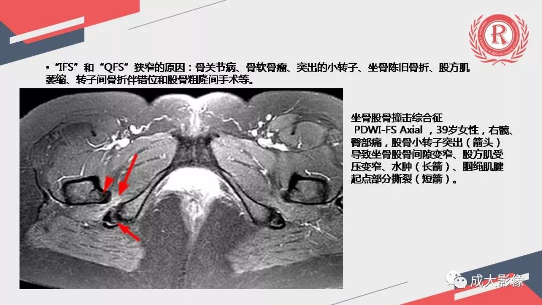 影像PPT - 【PPT】坐骨股骨撞击综合征MR影像诊断-28 影像PPT - 【PPT】坐骨股骨撞击综合征MR影像诊断-28