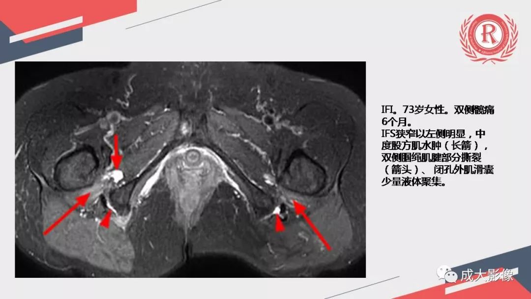 影像PPT - 【PPT】坐骨股骨撞击综合征MR影像诊断-30 影像PPT - 【PPT】坐骨股骨撞击综合征MR影像诊断-30