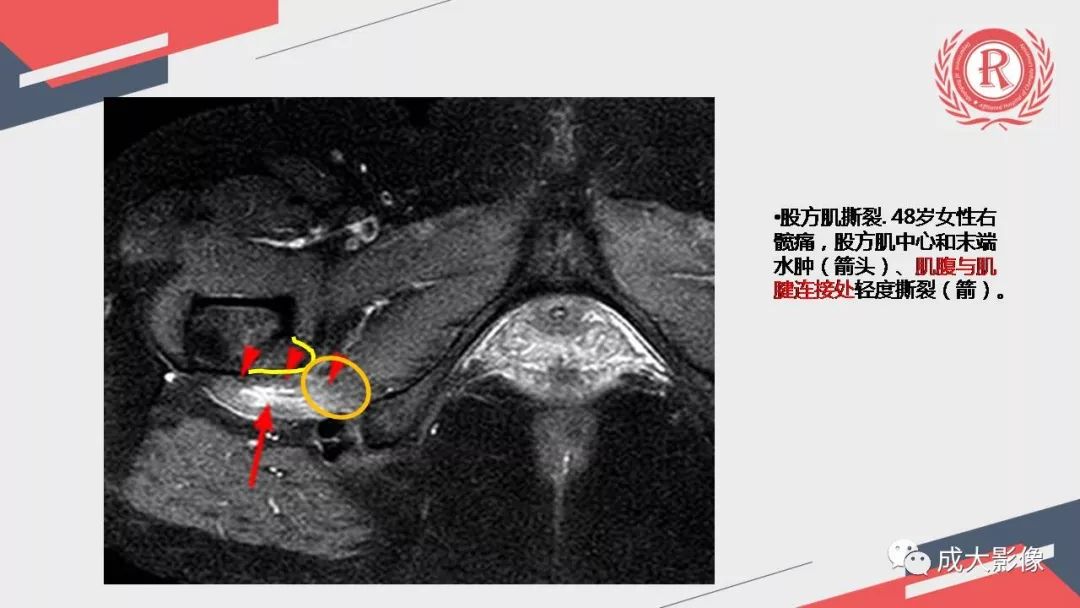 影像PPT - 【PPT】坐骨股骨撞击综合征MR影像诊断-33 影像PPT - 【PPT】坐骨股骨撞击综合征MR影像诊断-33