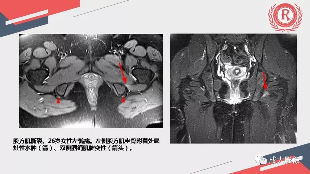 影像PPT - 【PPT】坐骨股骨撞击综合征MR影像诊断-34 影像PPT - 【PPT】坐骨股骨撞击综合征MR影像诊断-34