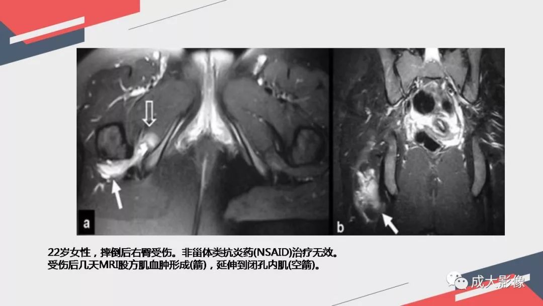 影像PPT - 【PPT】坐骨股骨撞击综合征MR影像诊断-35 影像PPT - 【PPT】坐骨股骨撞击综合征MR影像诊断-35