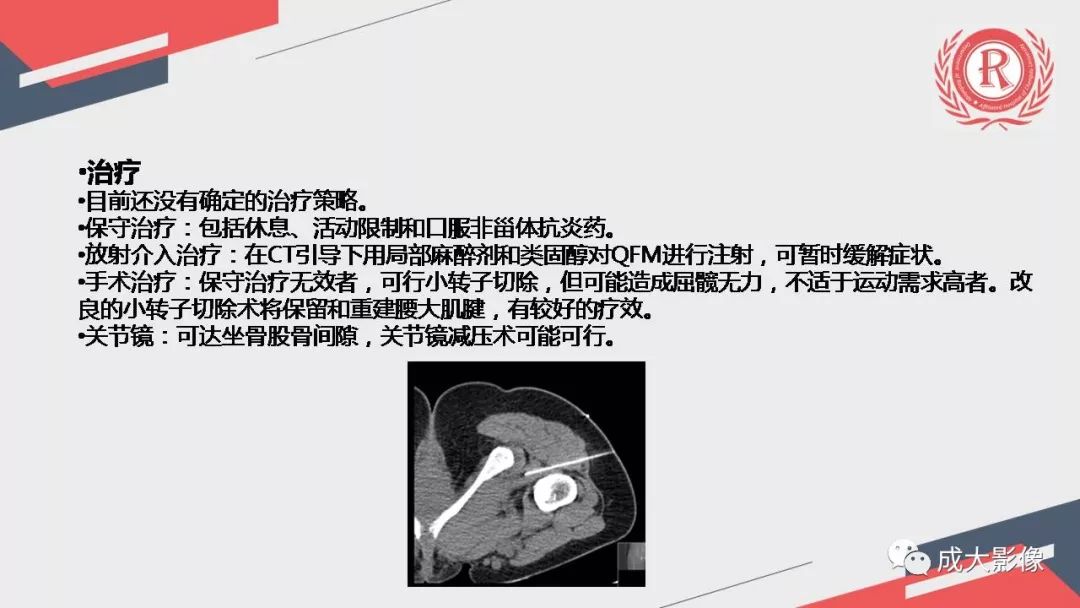 影像PPT - 【PPT】坐骨股骨撞击综合征MR影像诊断-37 影像PPT - 【PPT】坐骨股骨撞击综合征MR影像诊断-37