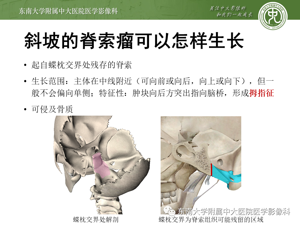 影像PPT - 【PPT】斜坡区脊索瘤的故事-12