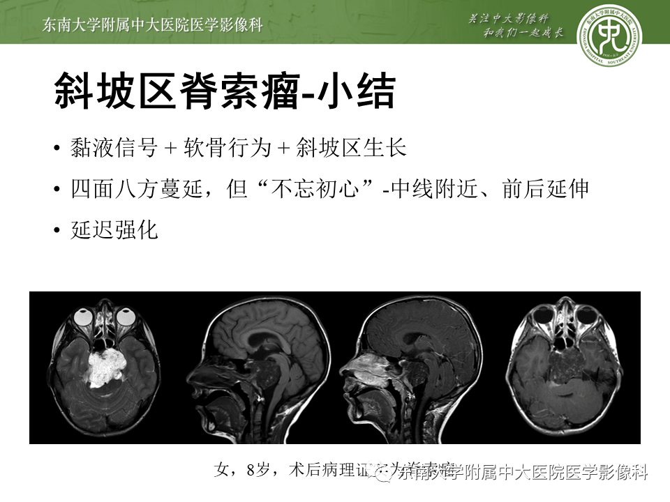 影像PPT - 【PPT】斜坡区脊索瘤的故事-13