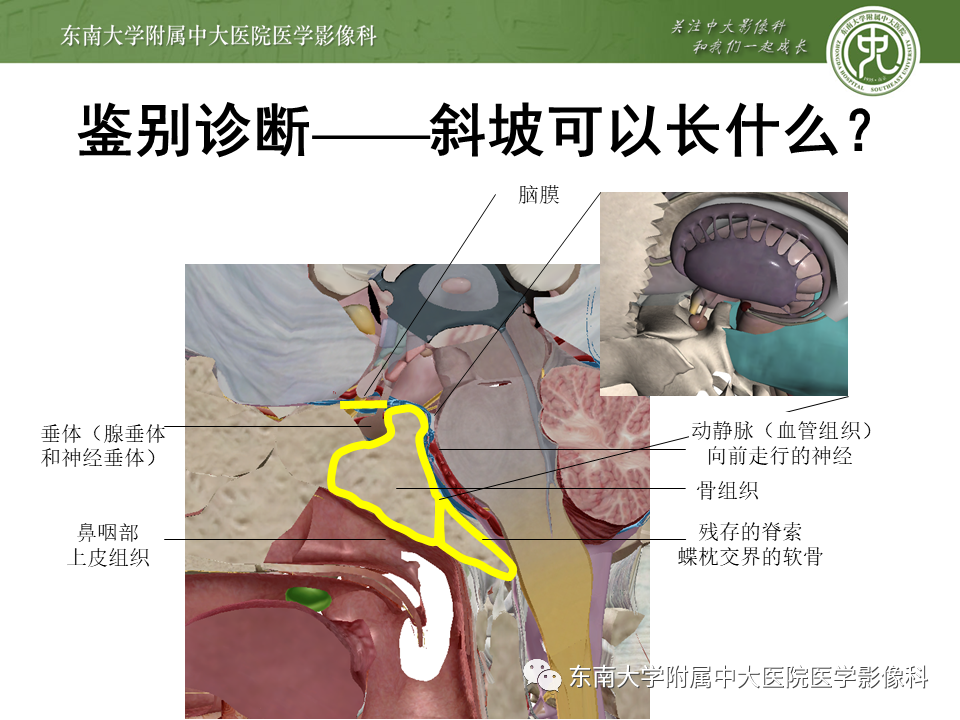 影像PPT - 【PPT】斜坡区脊索瘤的故事-15