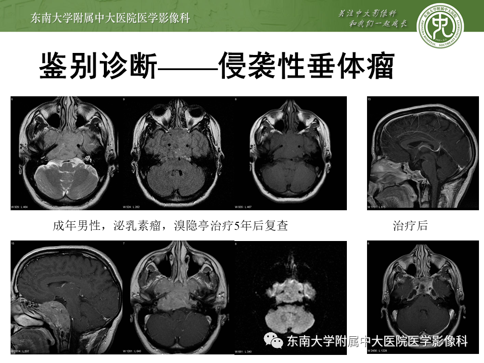 影像PPT - 【PPT】斜坡区脊索瘤的故事-18