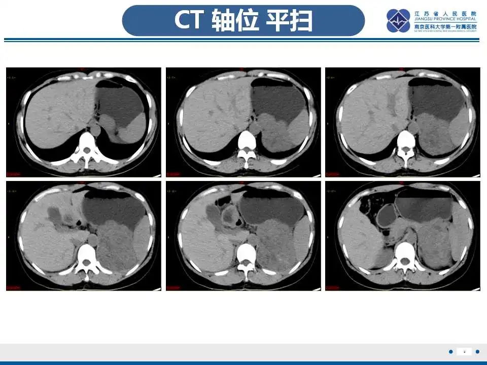 影像PPT - 【PPT】肾上腺区占位——胃间质瘤-3