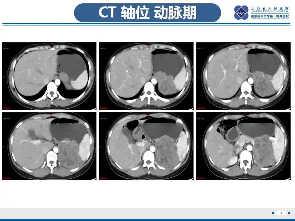 影像PPT - 【PPT】肾上腺区占位——胃间质瘤-4