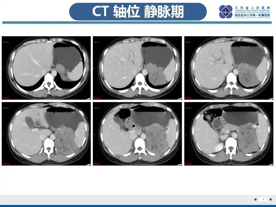 影像PPT - 【PPT】肾上腺区占位——胃间质瘤-5