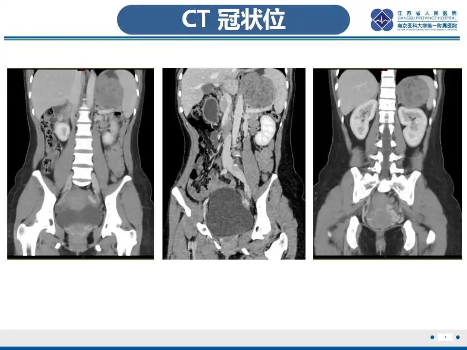 影像PPT - 【PPT】肾上腺区占位——胃间质瘤-6