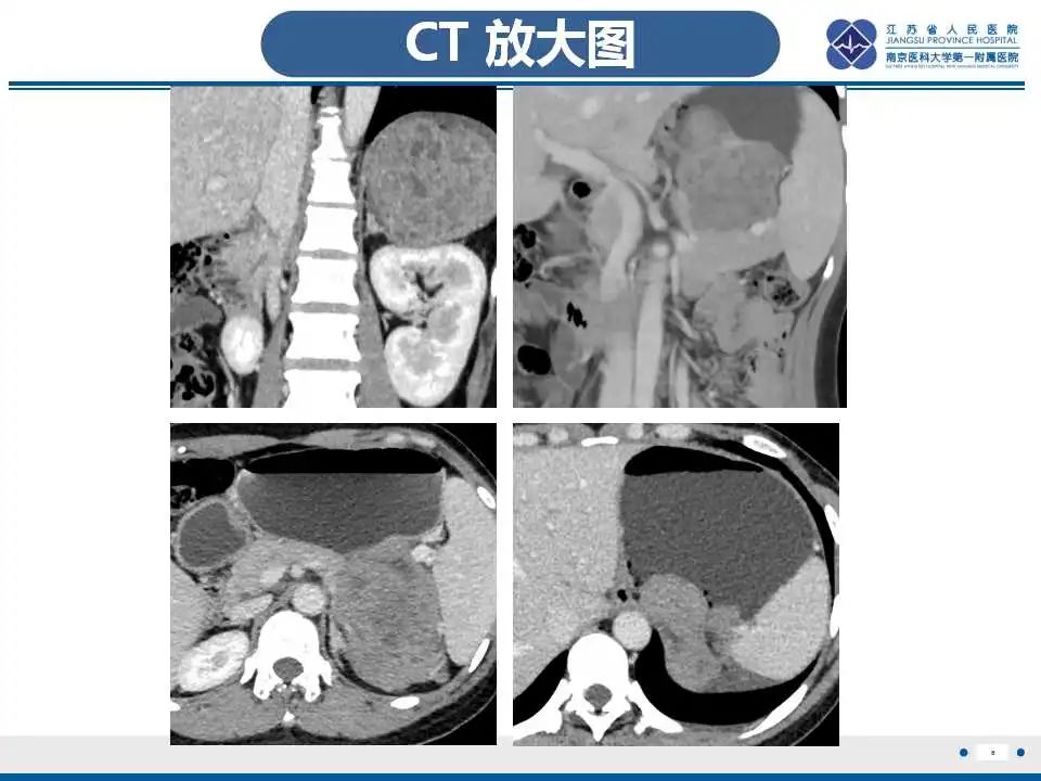 影像PPT - 【PPT】肾上腺区占位——胃间质瘤-7