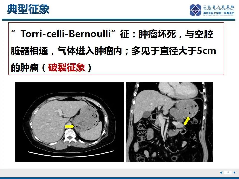 影像PPT - 【PPT】肾上腺区占位——胃间质瘤-21