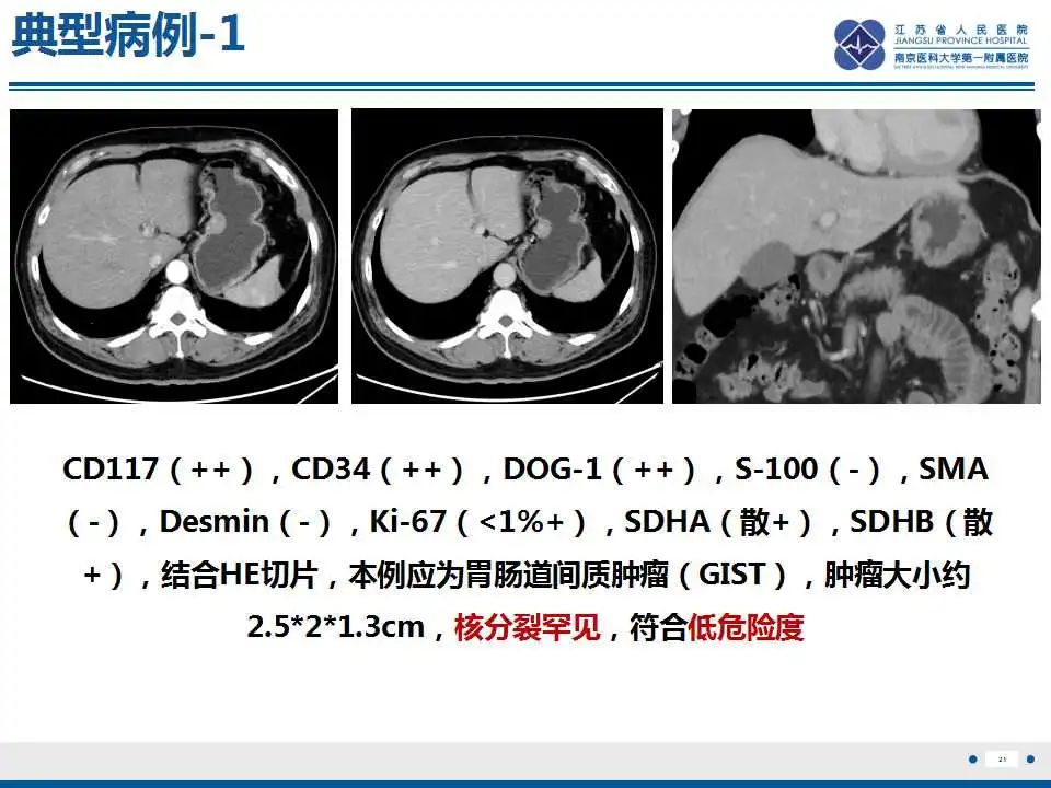 影像PPT - 【PPT】肾上腺区占位——胃间质瘤-22