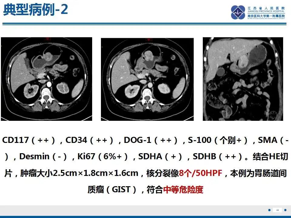 影像PPT - 【PPT】肾上腺区占位——胃间质瘤-23