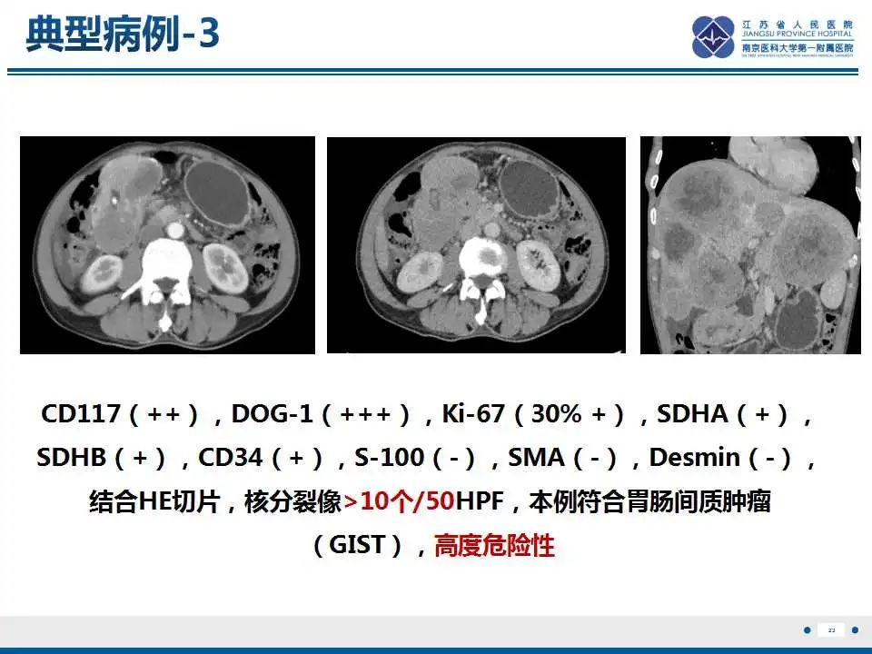 影像PPT - 【PPT】肾上腺区占位——胃间质瘤-24