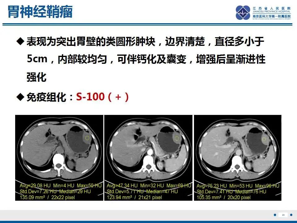 影像PPT - 【PPT】肾上腺区占位——胃间质瘤-30