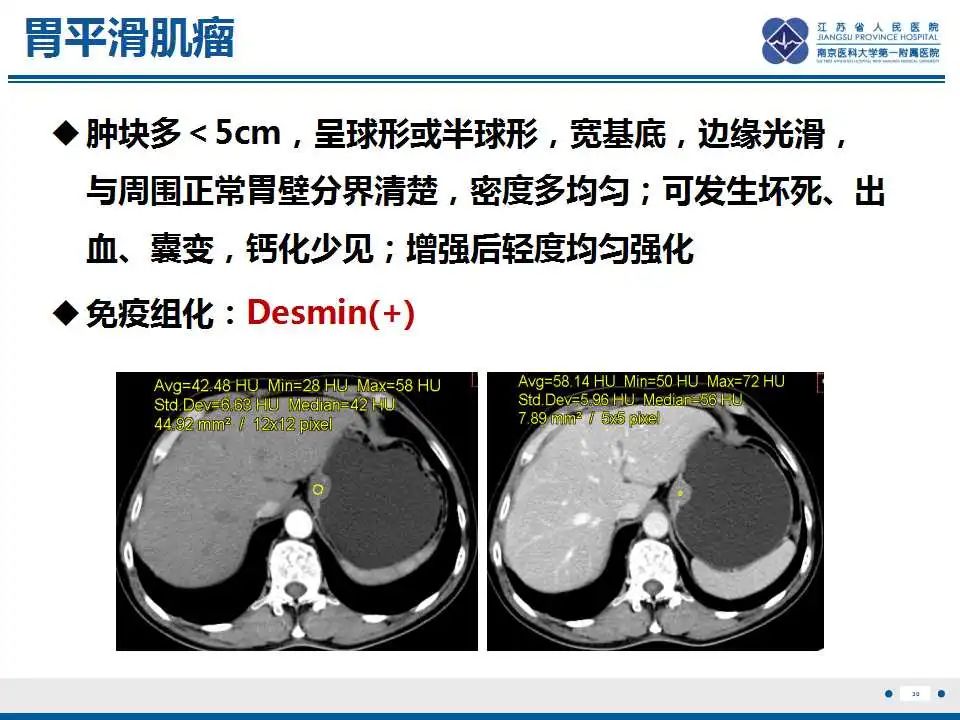 影像PPT - 【PPT】肾上腺区占位——胃间质瘤-31