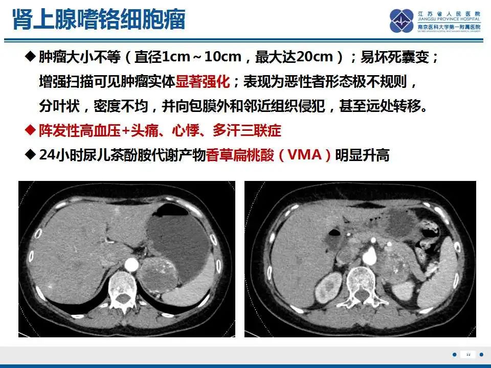 影像PPT - 【PPT】肾上腺区占位——胃间质瘤-33