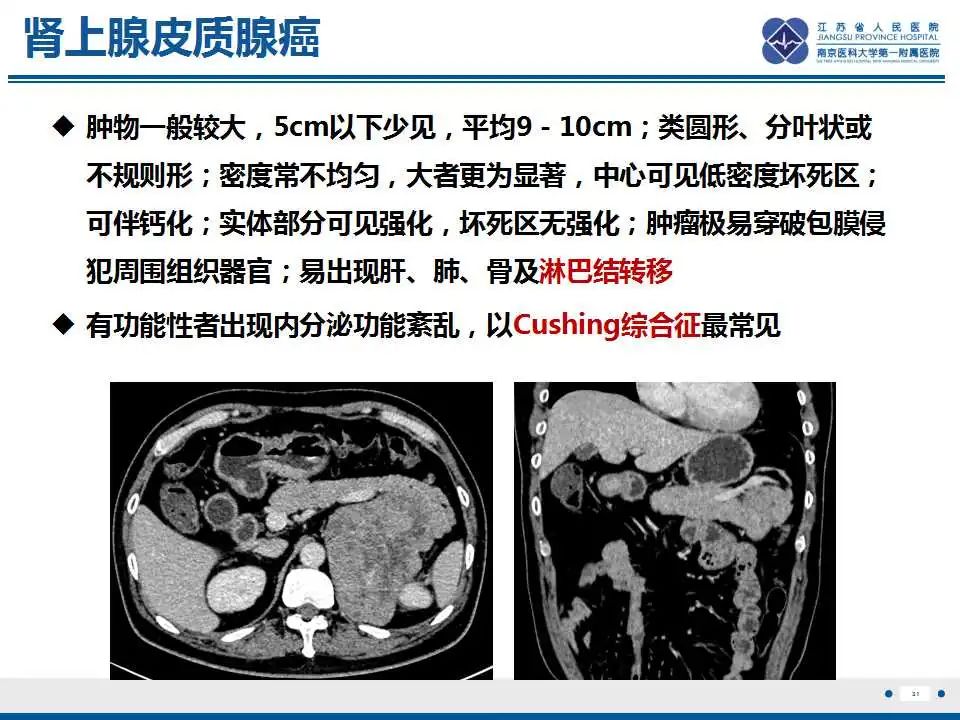 影像PPT - 【PPT】肾上腺区占位——胃间质瘤-32
