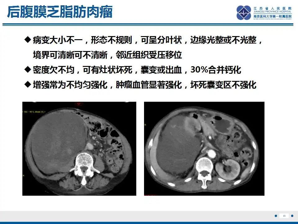 影像PPT - 【PPT】肾上腺区占位——胃间质瘤-34