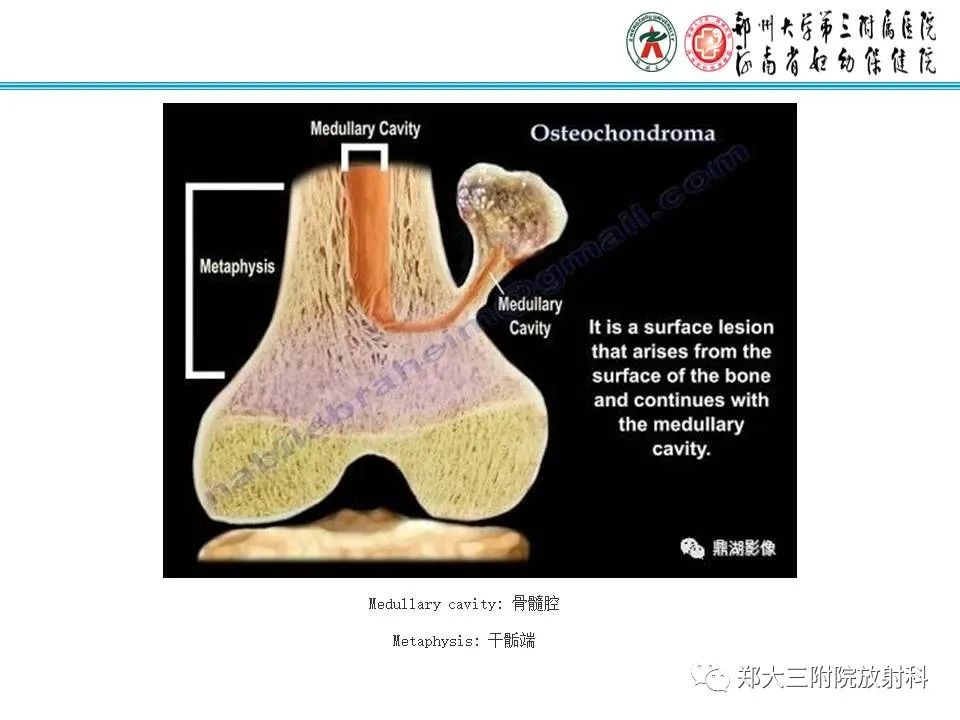 影像PPT - 【PPT】骨软骨瘤的影像诊断-5