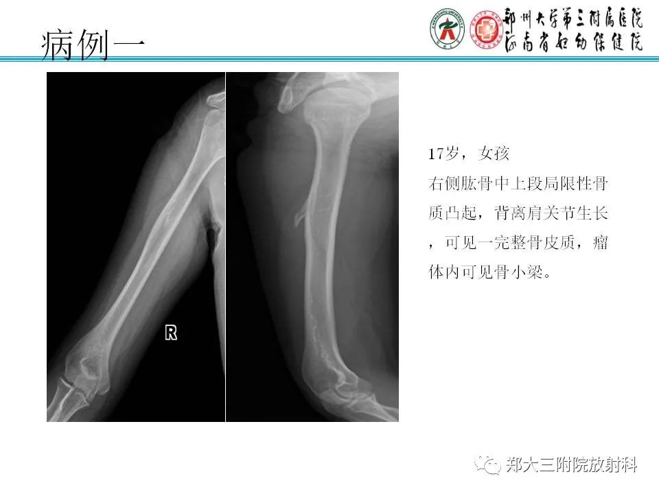 影像PPT - 【PPT】骨软骨瘤的影像诊断-12