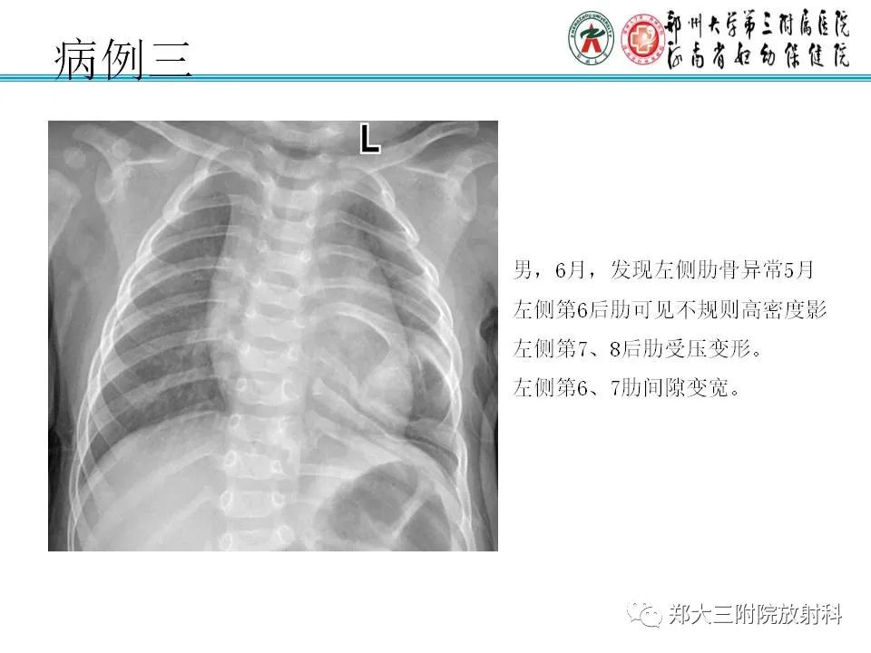 影像PPT - 【PPT】骨软骨瘤的影像诊断-14