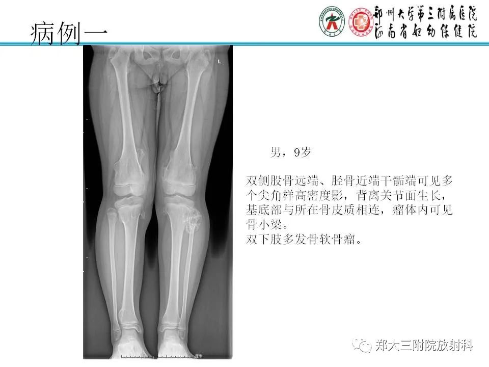 影像PPT - 【PPT】骨软骨瘤的影像诊断-13