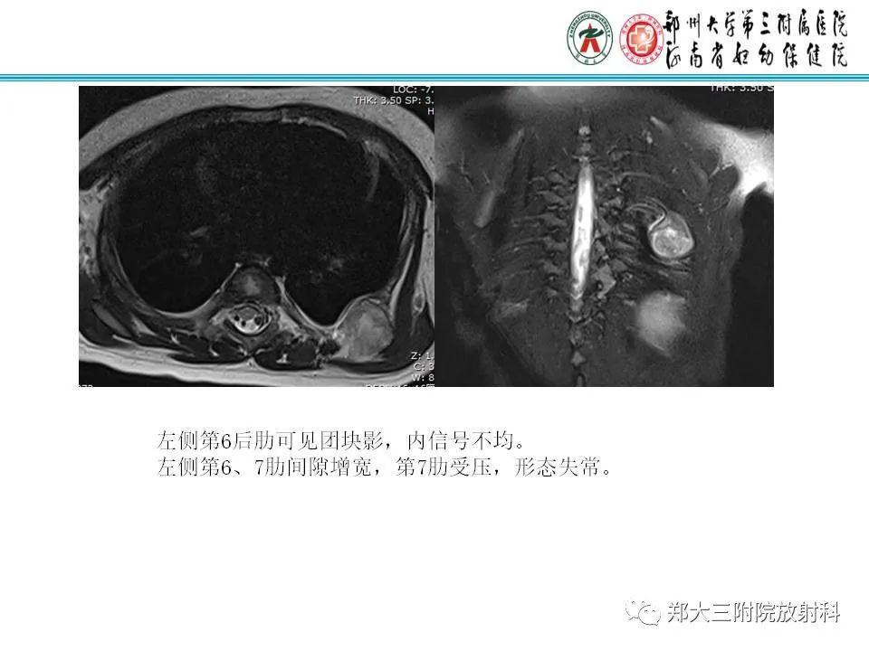 影像PPT - 【PPT】骨软骨瘤的影像诊断-16