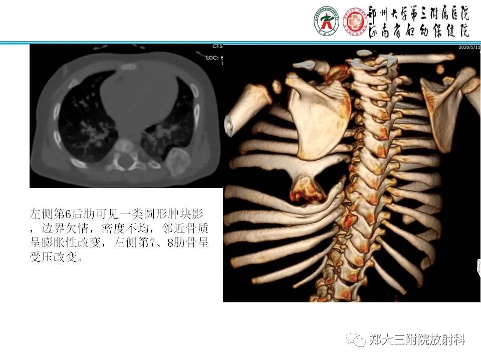 影像PPT - 【PPT】骨软骨瘤的影像诊断-15