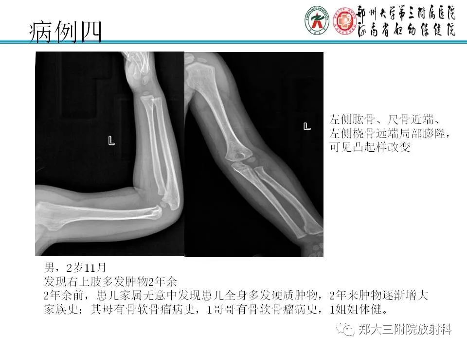 影像PPT - 【PPT】骨软骨瘤的影像诊断-17