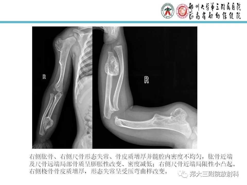 影像PPT - 【PPT】骨软骨瘤的影像诊断-18