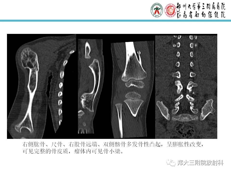 影像PPT - 【PPT】骨软骨瘤的影像诊断-20