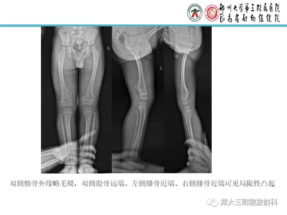 影像PPT - 【PPT】骨软骨瘤的影像诊断-19