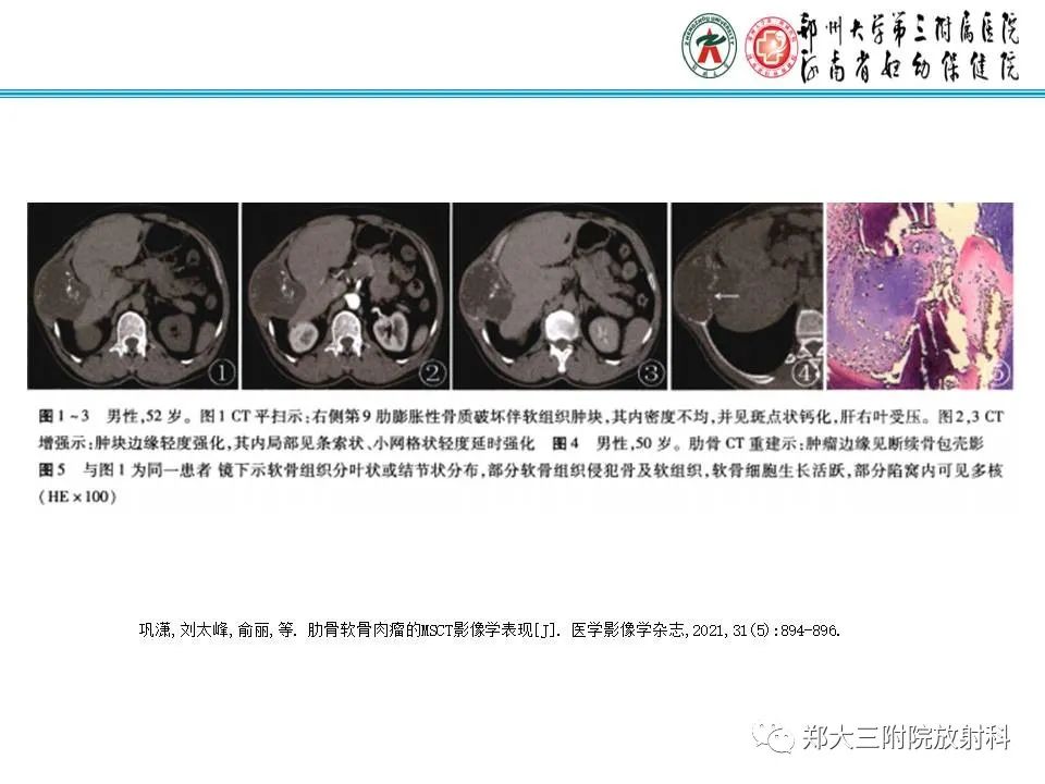 影像PPT - 【PPT】骨软骨瘤的影像诊断-23