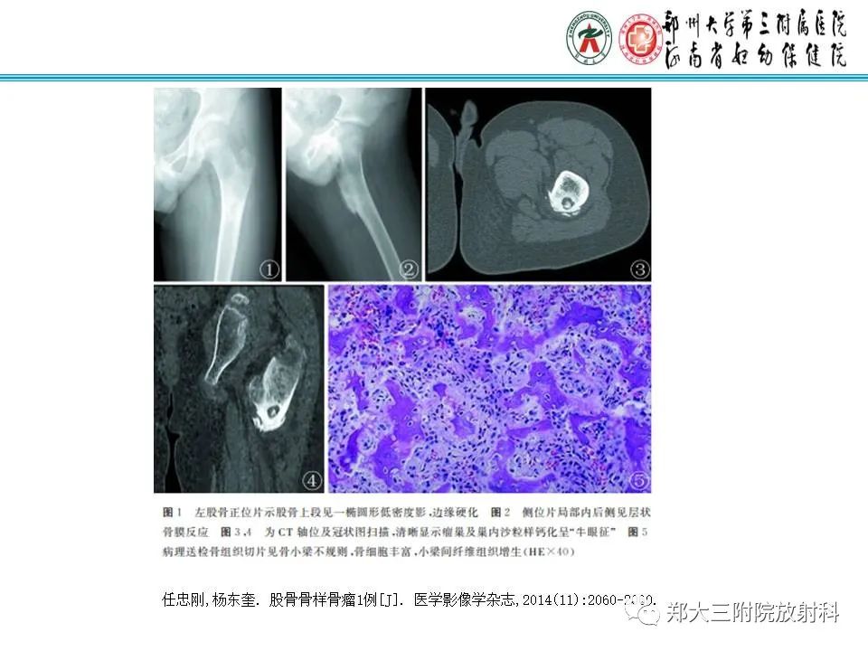 影像PPT - 【PPT】骨软骨瘤的影像诊断-25