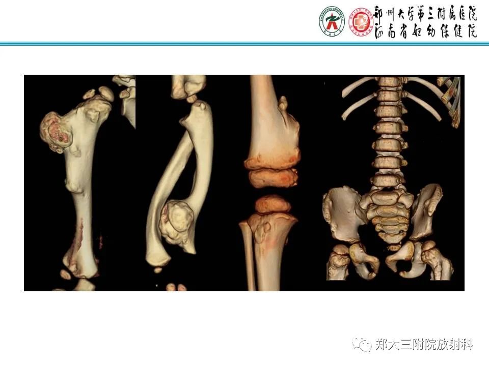 影像PPT - 【PPT】骨软骨瘤的影像诊断-21