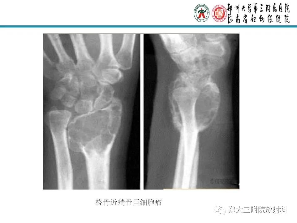 影像PPT - 【PPT】骨软骨瘤的影像诊断-27