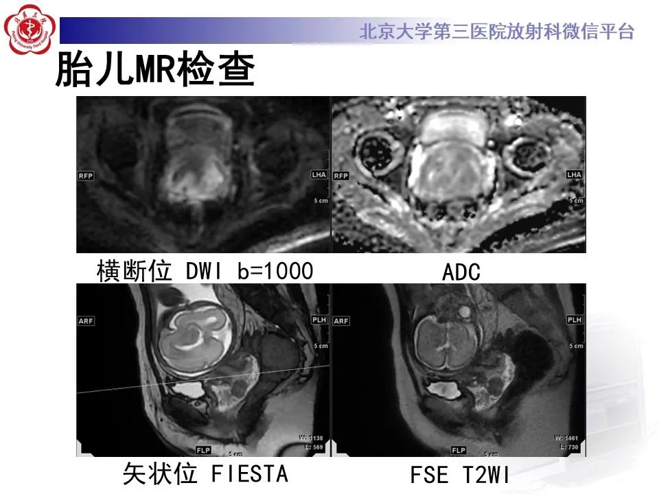 影像PPT - 【PPT】宫颈腺癌 & 神经内分泌癌-3