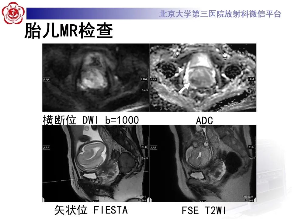 影像PPT - 【PPT】宫颈腺癌 & 神经内分泌癌-4