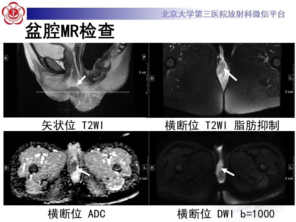 影像PPT - 【PPT】宫颈腺癌 & 神经内分泌癌-7
