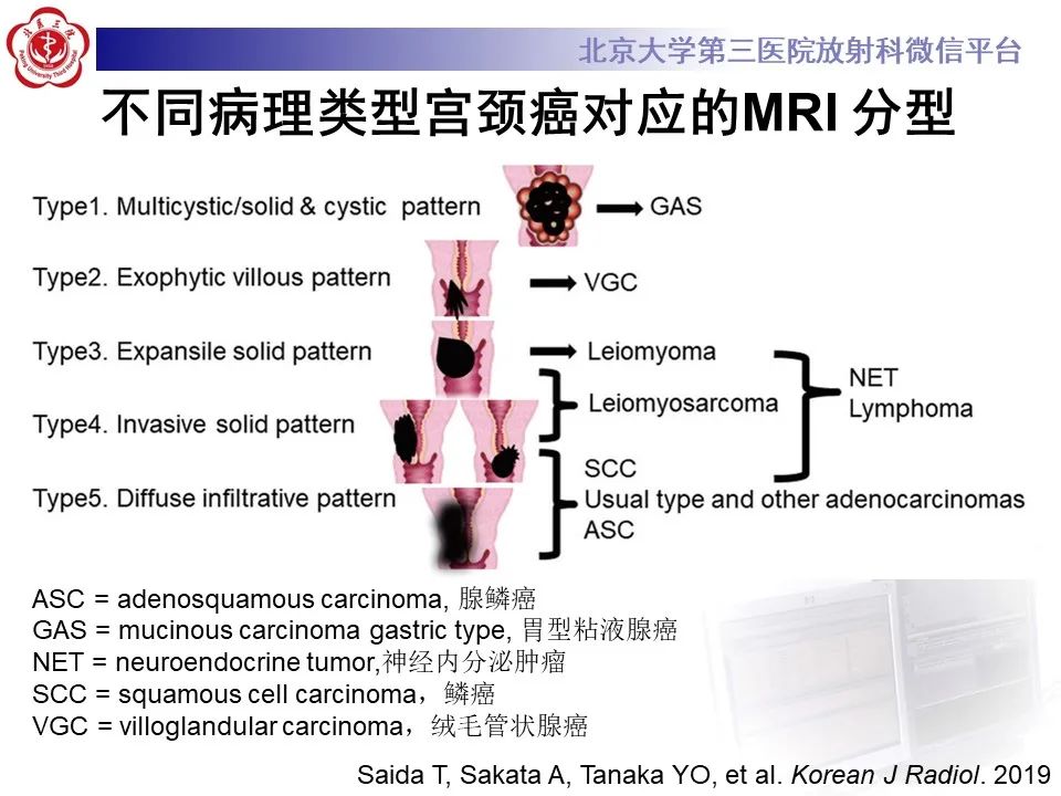 影像PPT - 【PPT】宫颈腺癌 & 神经内分泌癌-14