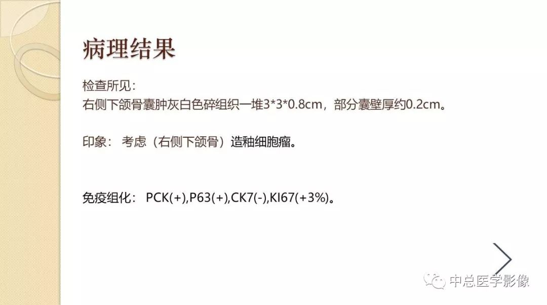 影像PPT - 【PPT】颌骨造釉细胞瘤CT影像表现-8