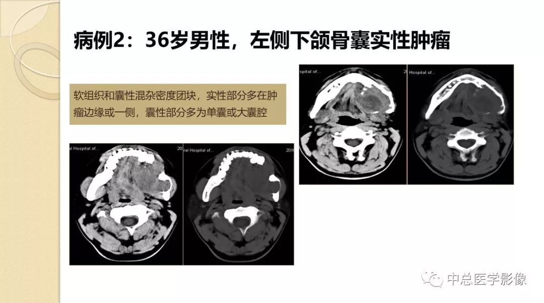 影像PPT - 【PPT】颌骨造釉细胞瘤CT影像表现-9