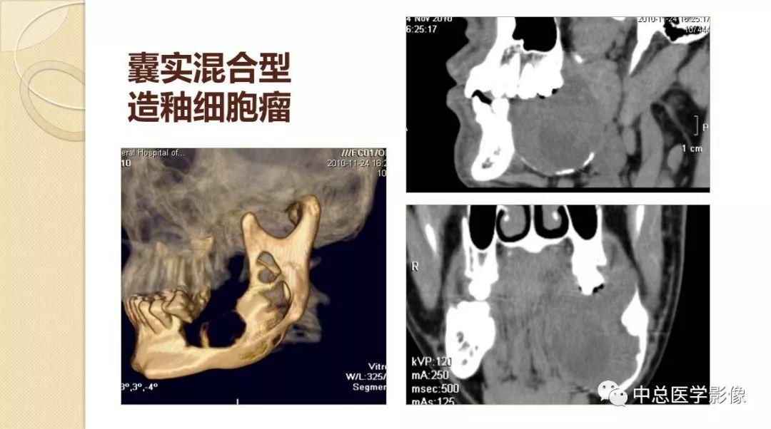 影像PPT - 【PPT】颌骨造釉细胞瘤CT影像表现-10